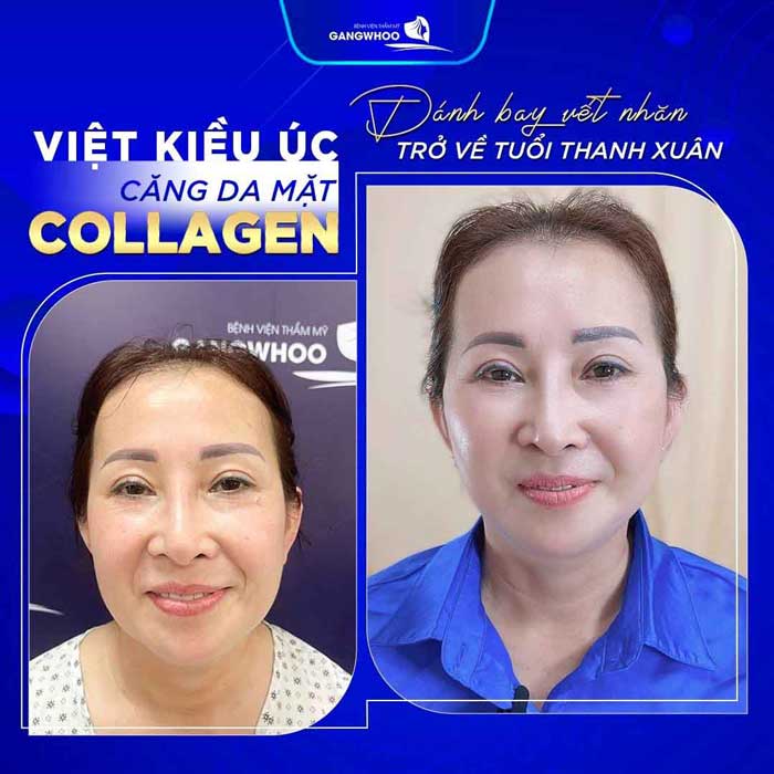 Các Tác Dụng Của Căng Da Mặt