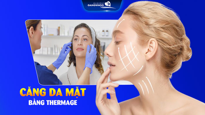Căng da mặt thermage