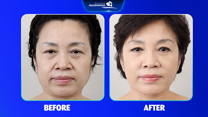 Căng da mặt thermage