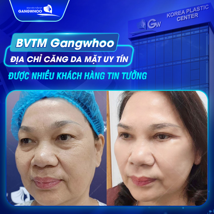 Biến Chứng Khi Căng Da Mặt Bằng Chỉ