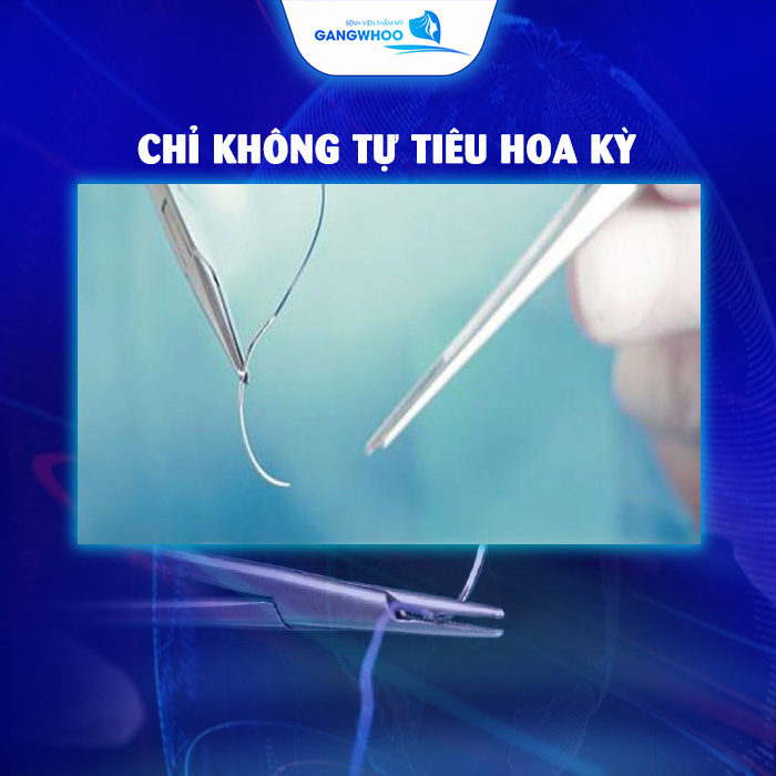 Các Loại Chỉ Căng Da Mặt