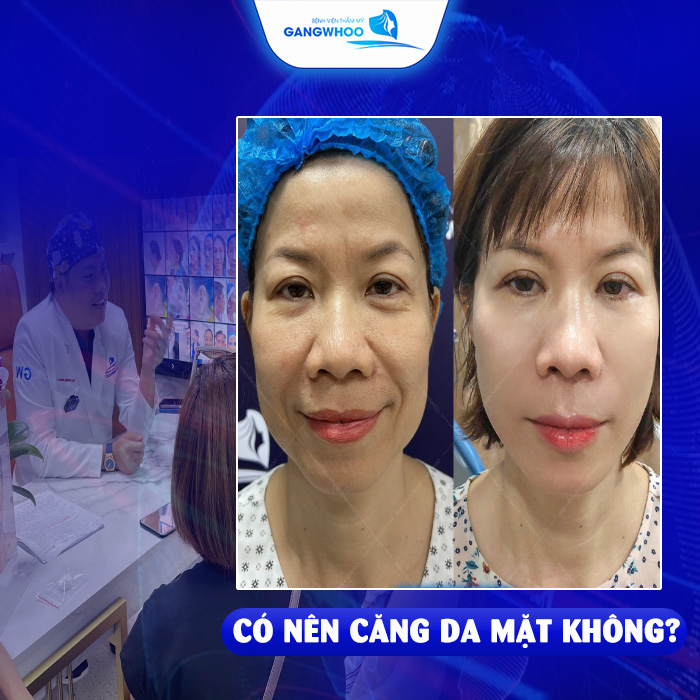 Các Loại Chỉ Căng Da Mặt