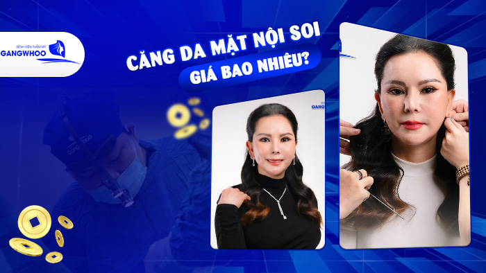Căng Da Mặt Nội Soi Giá Bao Nhiêu