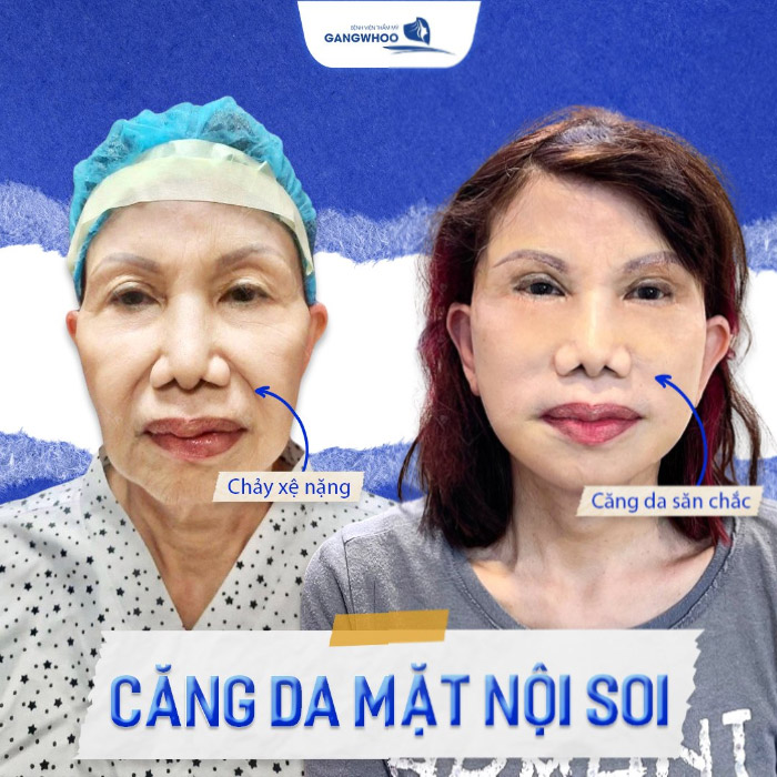 Các Tác Dụng Của Căng Da Mặt
